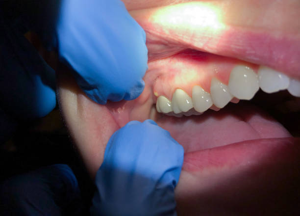 Best Dentist for Tooth Abscess  in Metter, GA